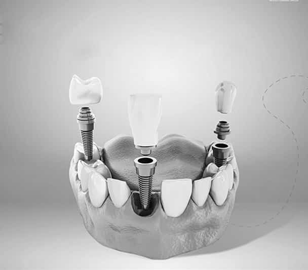 Dentus perfectus - implants - dental practice