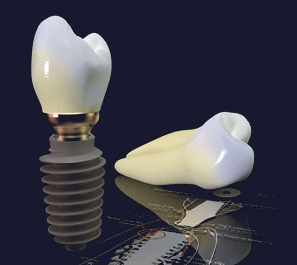 Dentus perfectus - dental implant