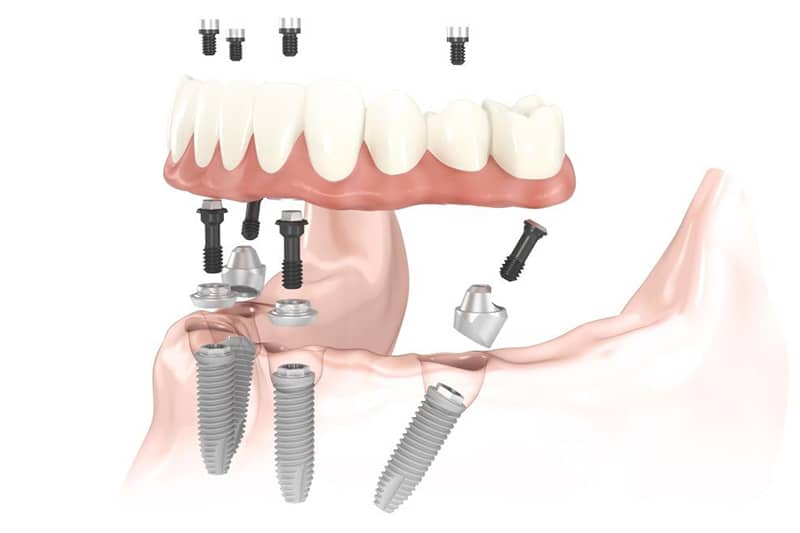 Dentus perfectus - implantologija - all on 4