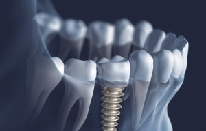 Dentus perfectus - implantologija - što su zubni implantati? Dentus perfectus - implantologija - što su zubni implantati?