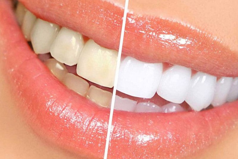 Dentus perfectus - bleaching teeth