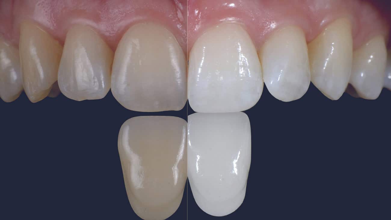 Dentus perfectus - izbjeljivanje zubi prije i poslije 1 Usporedni prikaz zubi prije i nakon izbjeljivanja, s jasno vidljivom promjenom u boji i sjaju - Dentus perfectus - izbjeljivanje zubi prije i poslije 1