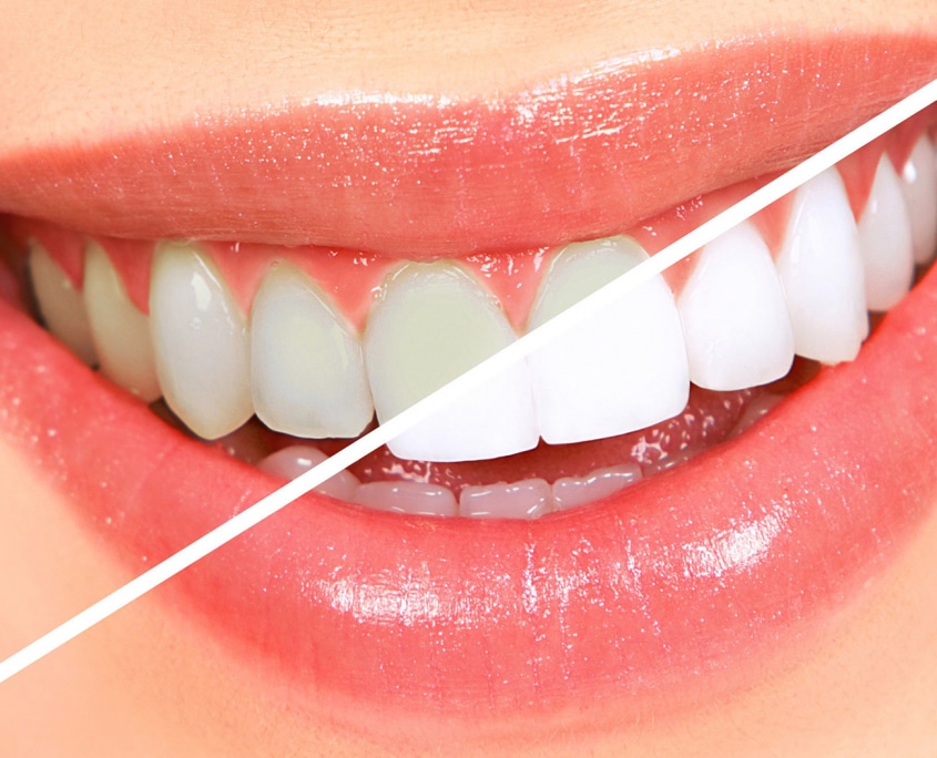 Dentus perfectus - izbjeljivanje zubi prije i poslije