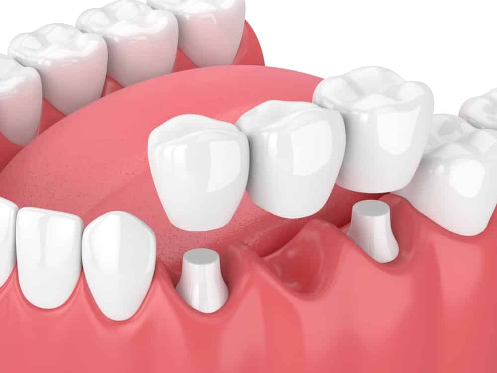 Dentus perfectus - the benefits of a dental bridge