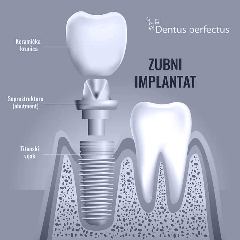 Dentus perfectus - ugradnja zubnog implantata