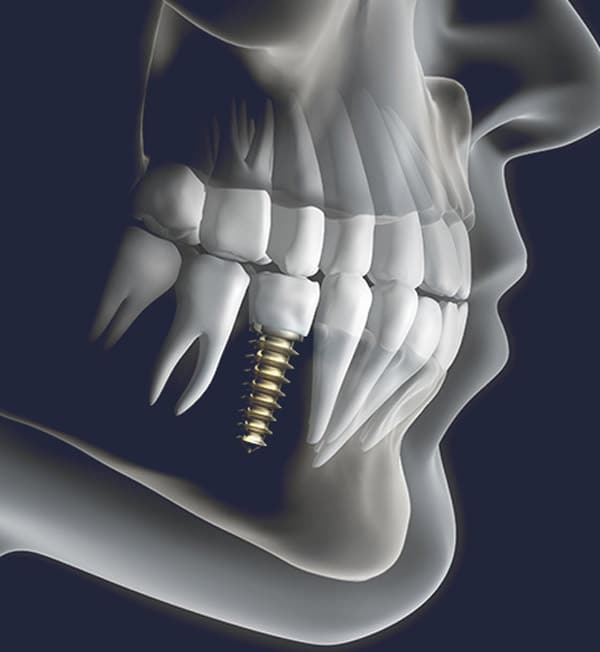 Dentus perfectus - dental implants