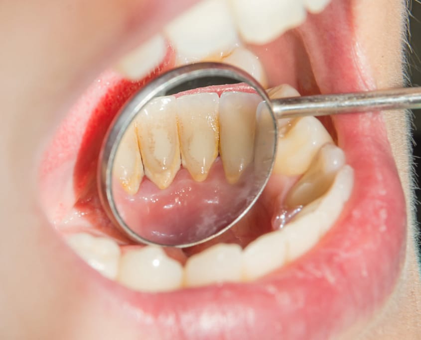 Dentus perfectus - zubni kamenac
