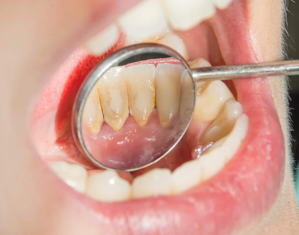 Dentus perfectus - zubni kamenac