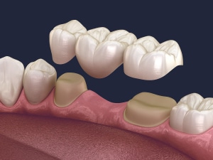 dental bridge Dentus Perfectus