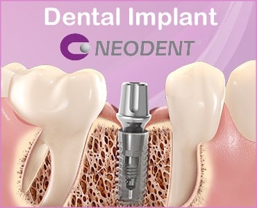 Dentalni implantati - Neodent - Dentus perfectus