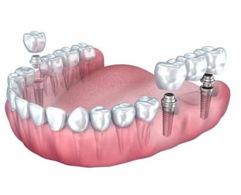 Dentus perfectsu - most na implantatima