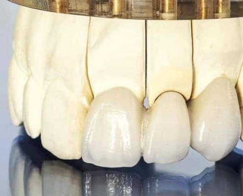 Dentus perfectus - most na prirodnim zubima