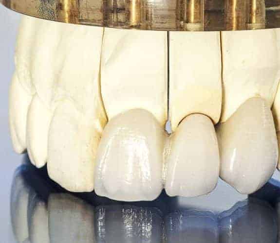 Dentus perfectus - dental bridge on natural teeth