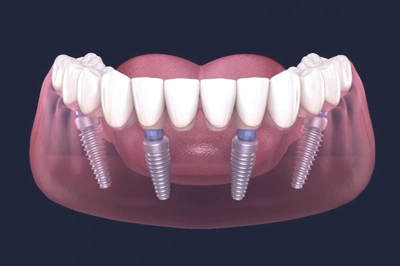 Most na 4 implantata - Dentus perfectus