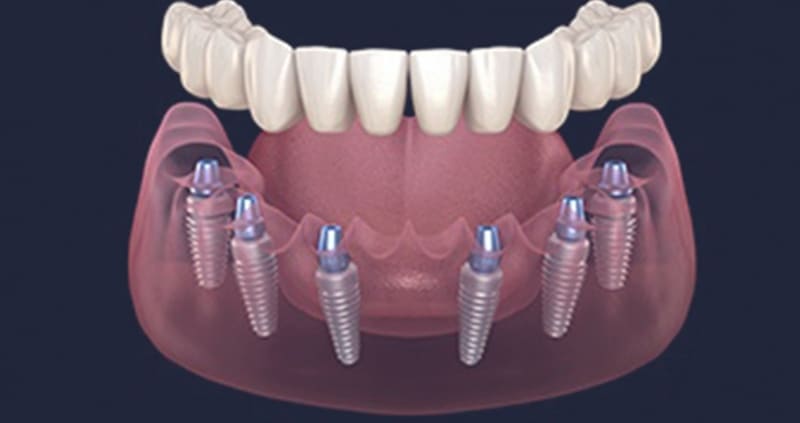 Most na 6 implantata- Dentus perfectus