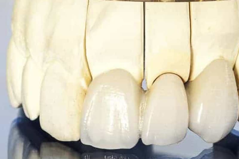Most na prirodnim zubima 3 - Dentus perfectus