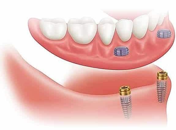 Zubna proteza 2-4 implantata - Dentus perfectus