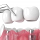 Zubni most na implantatima - Dentus perfectus stomatološka ordinacija