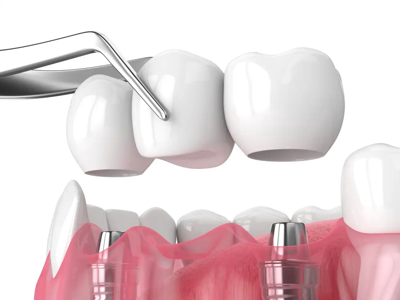 Zubni most na implantatima - Dentus perfectus stomatološka ordinacija Zubni most na implantatima - Dentus perfectus stomatološka ordinacija