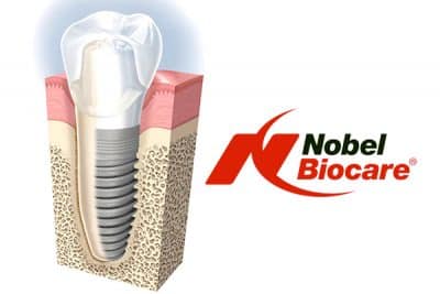 Dentalni implantati - Nobel Biocare - Dentus perfectus