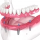 Zubna proteza na četiri implantata u donjoj čeljusti, prikazana kao stabilno i funkcionalno rješenje za nedostatak zuba -zubna proteza 2-4 implantata - Dentus perfectus