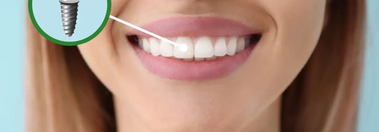 zašto je zubni implantat najbolje rješenje za izgubljen zub