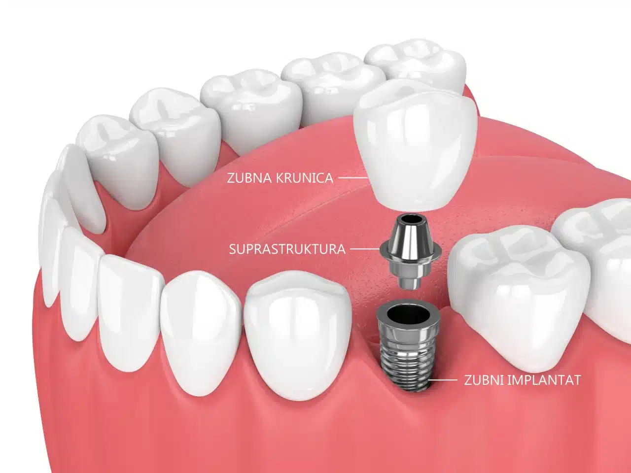 zubni implantati cijena