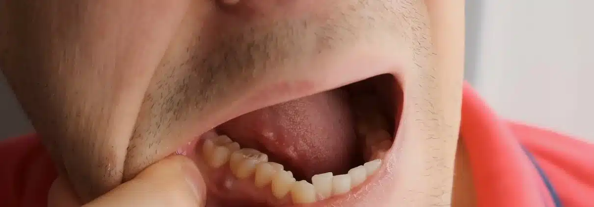 upala zuba