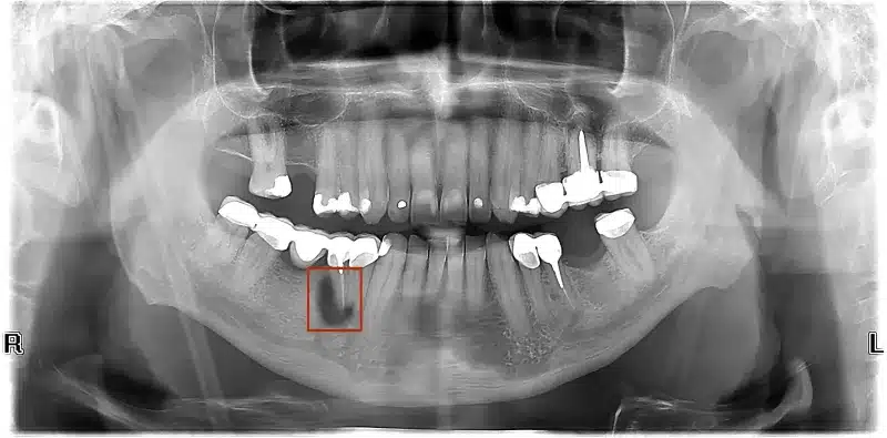 gangrena zuba
