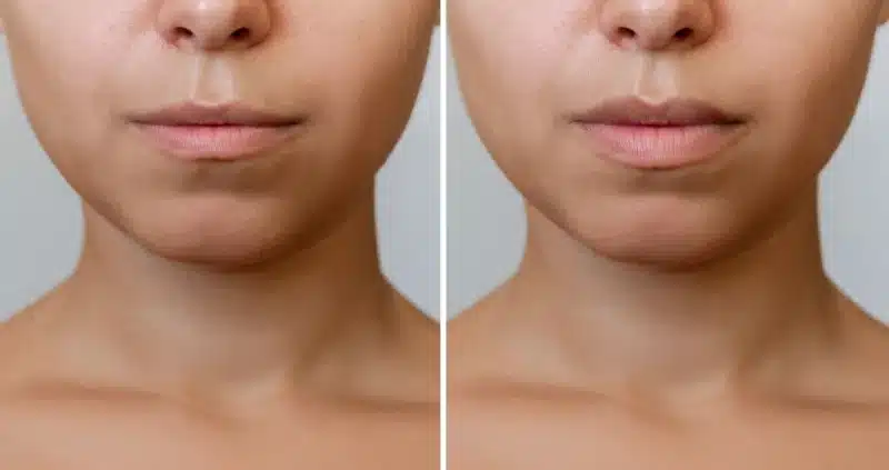 povećanje usana dermalnim filerima before & after