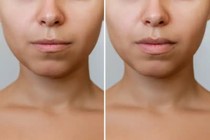 povećanje usana dermalnim filerima before & after