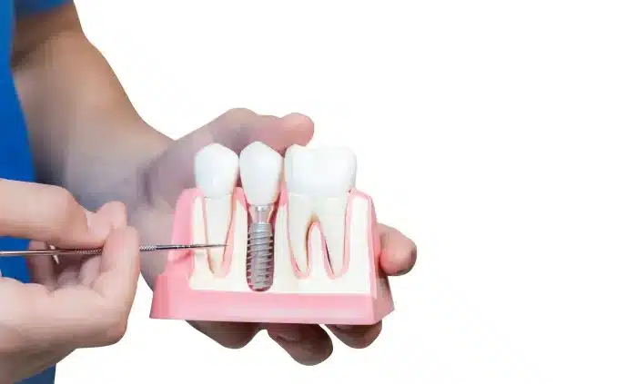 cijena zubnog implantata