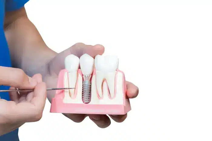 cijena zubnog implantata