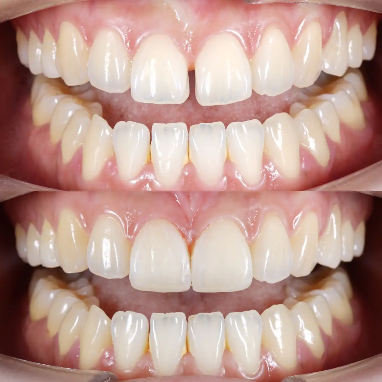 Prije ugradnje ljuskica i poslije ugradnje ljuskica za zube