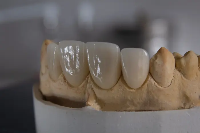 Zubne krunice prednja fronta