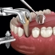 prikaz kako izgleda vađenje zuba i ugradnja implantata u istom zahvatu - imedijatna implantacija