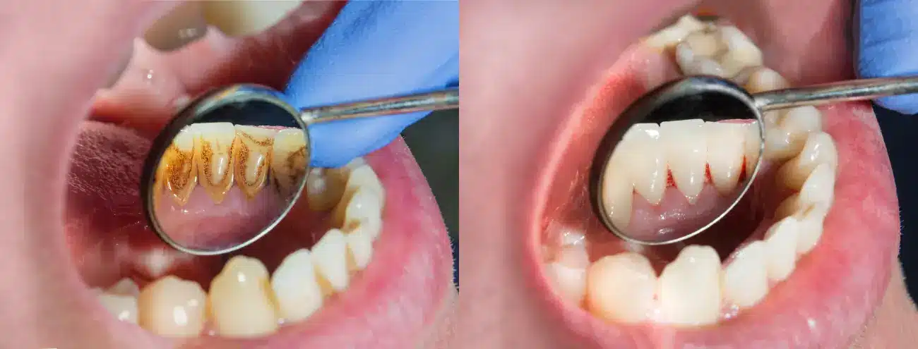 plak i bakterije na zubima