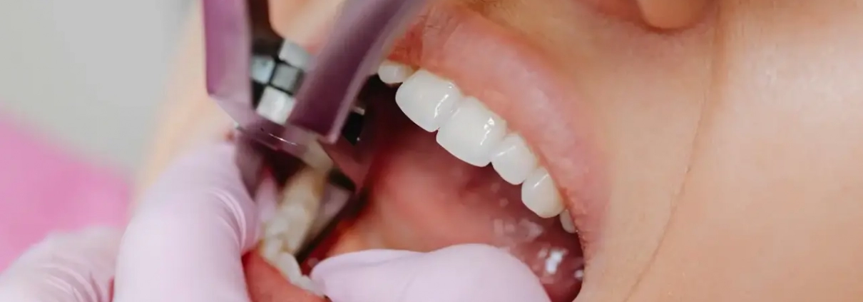 vađenje zuba oporavak