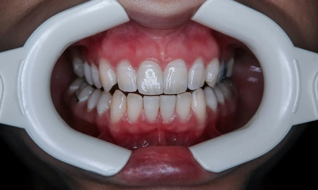 parodontologija Detaljan prikaz zdravih zuba i desni nakon završene terapije - Parodontologija - Dentus perfectus stomatološka ordinacija