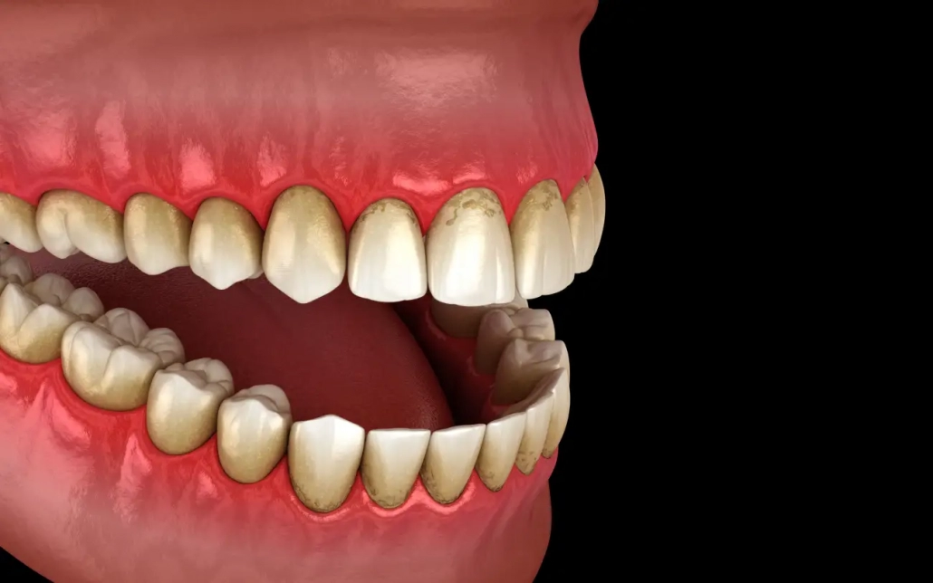 gingivitis i krvarenje desni oko zuba - Dentus perfectus stomatološka ordinacija Zatvoreni kadar usne šupljine s upaljenim desnima koja pokazuju znakove krvarenja i crvenila uzrokovanih gingivitisom - Dentus perfectus stomatološka ordinacija
