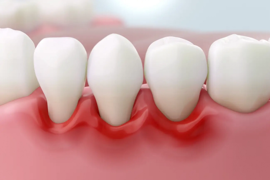 lijek za paradentozu - Dentus perfectus lijek za paradentozu - Dentus perfectus