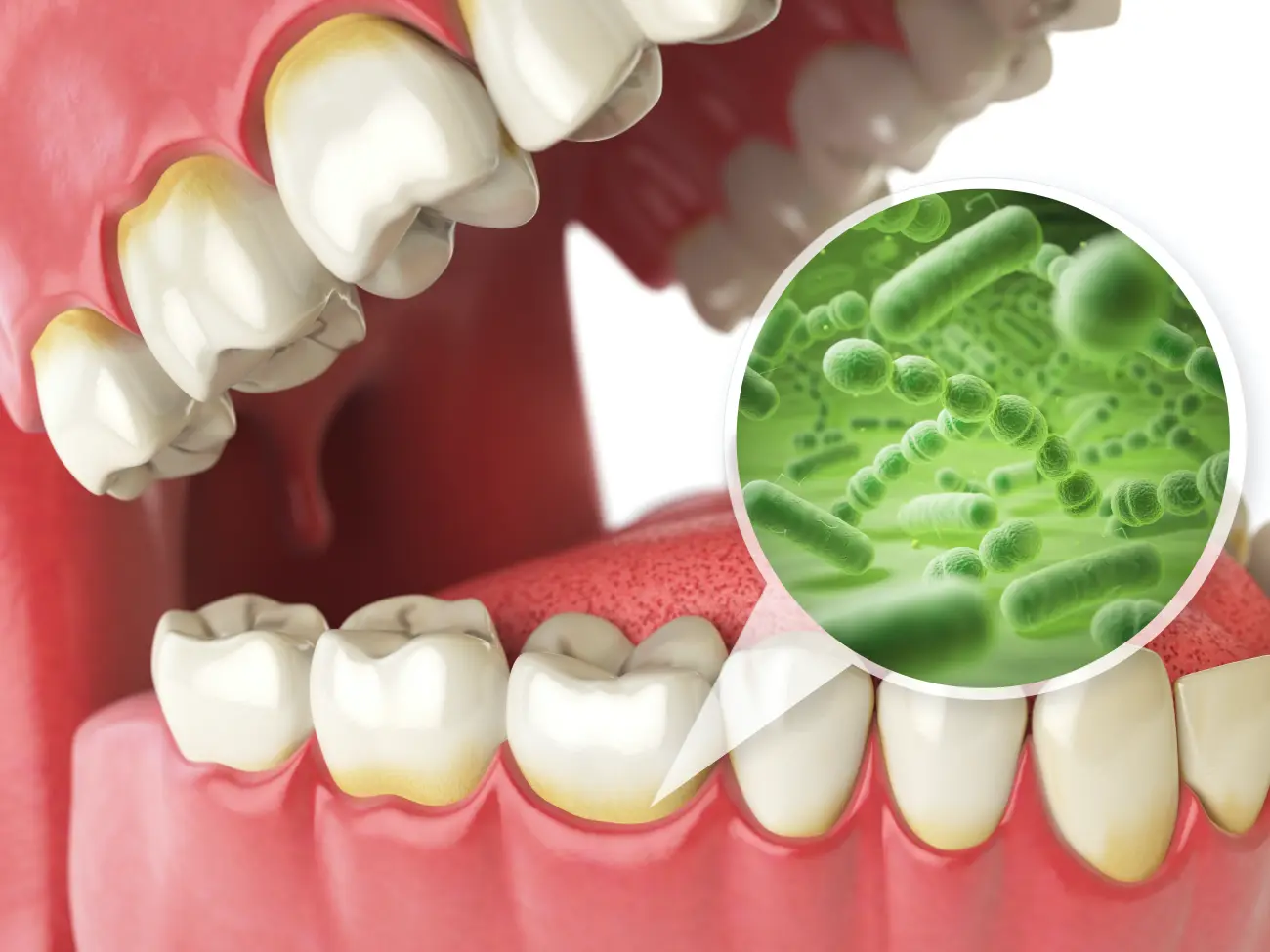 kariogene bakterije-Dentus perfectus prikaz mikroorganizama na površini zuba i desni te kariogenih bakterija u ustima -Dentus perfectus ordinacija