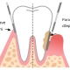 Parodontni džep - Dentus perfectus ordinacija