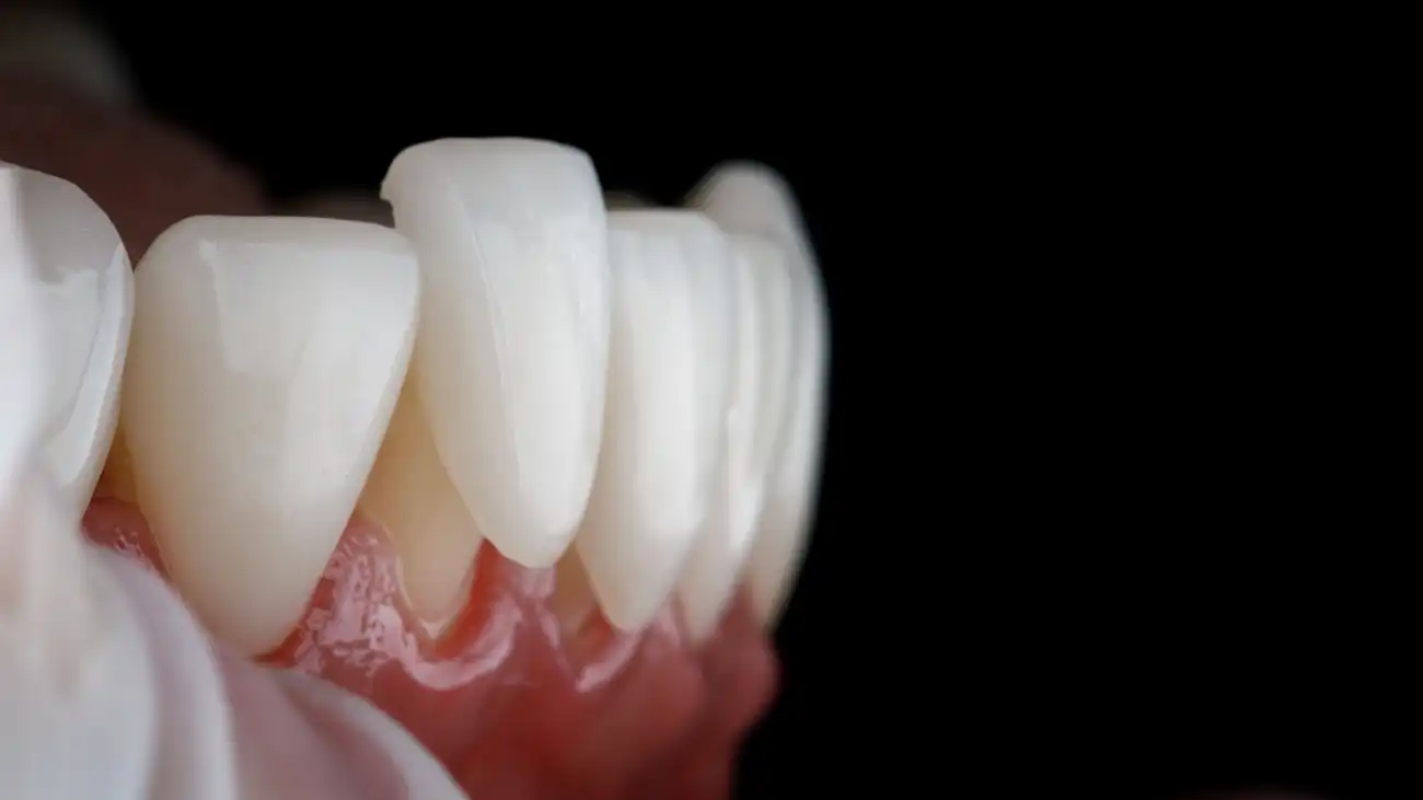 ljuskice za zube - dentus perfectus Precizna završna faza estetskog tretmana – trajno cementiranje ljuskice na prednji zub - postavljanje ljuskice za zube - Dentus perfectus ordinacija
