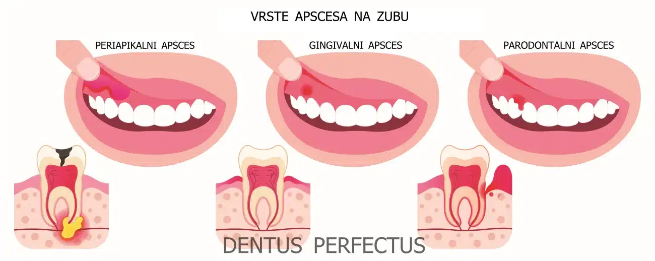 Zubni apsces - Dentus perfectus Zubni apsces - Dentus perfectus