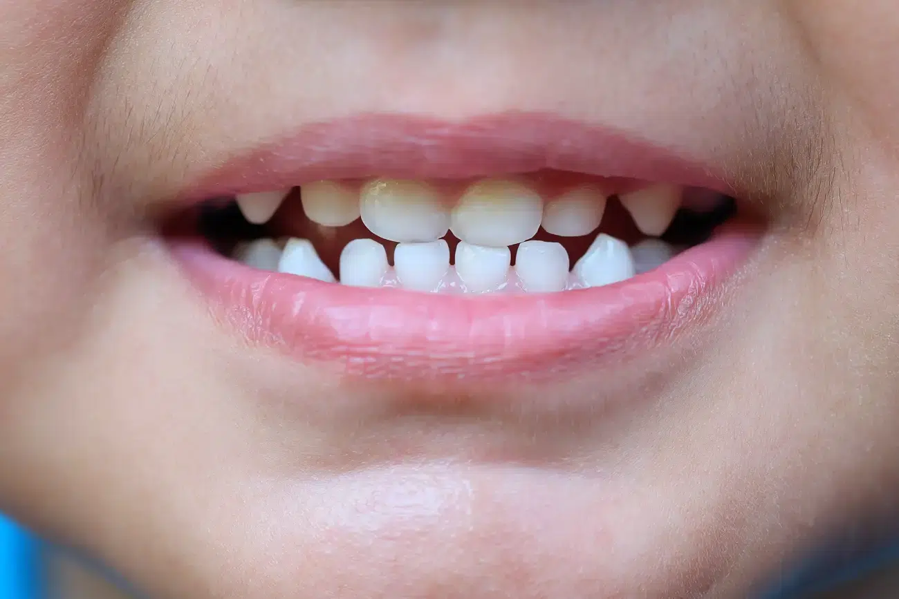 zdravi mlijecni zubi - Dentus perfectus ordinacija zdravi mlijecni zubi - Dentus perfectus ordinacija