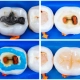 Zamjena amalgamske plombe kompozitom nakon lijecenja korijenskog kanala - Dentus perfectus ordinacija