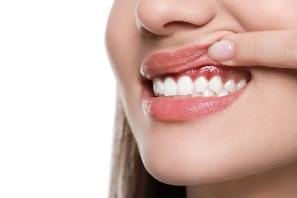 parodontitis i sklerodermija - Dentus perfectus Pacijentica sa sklerodermijom pokazuje znakove teškog parodontitisa – crvene, upaljene i bolne desni koje krvare, što ukazuje na povezanost autoimune bolesti s oralnim zdravljem - Dentus perfectus ordinacija