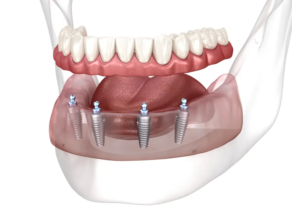 All-on-4-dental work - Dentus perfectus All on 4 teeth for the full arch on only 4 implants in the lower jaw