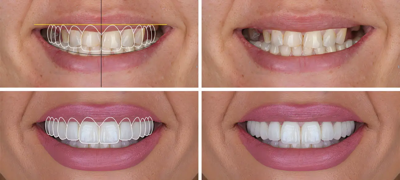 Dental Prothetics - Dentus perfectus dental office aesthetic dentistry transformation in Dentus perfectus dental office - Zagreb, Croatia
